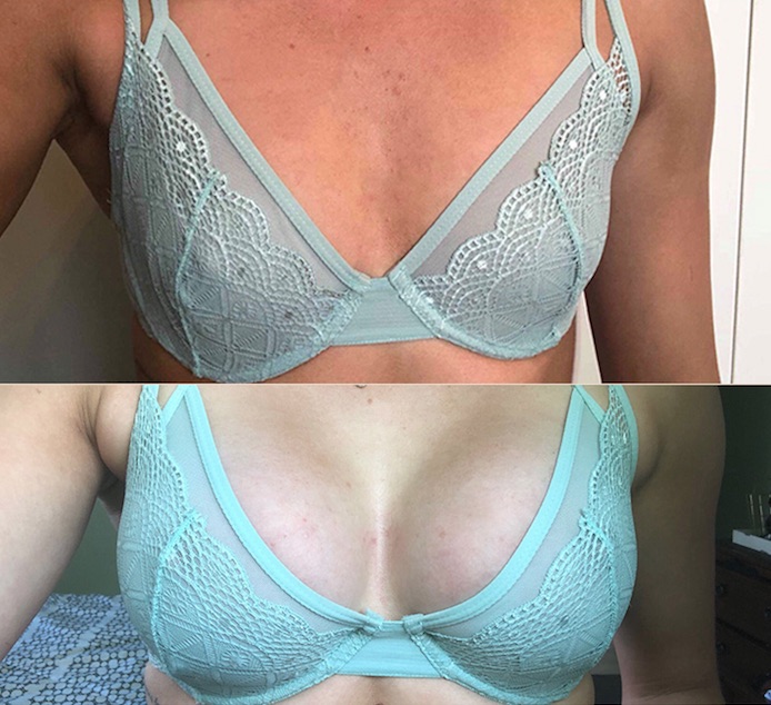 Breast Augmentation Before & After #311