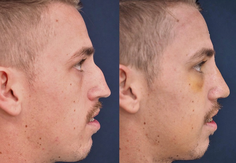 Dr Supasid Improves Ethan’s Breathing and Facial Aesthetics with Rhinoplasty Surgery in Thailand