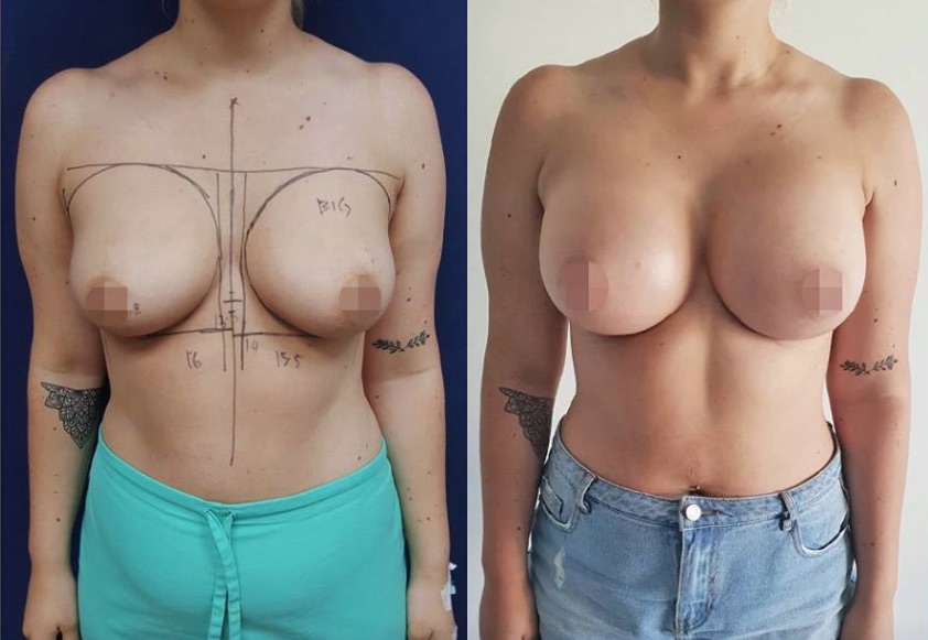 Breast Augmentation Before & After #313