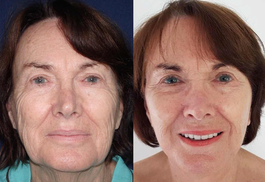 Facelift Before and After #32