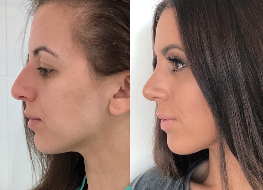 Charmaine’s Spectacular New Nose by CosMediTour Plastic Surgeon Dr Supasid