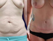 Mummy Makeover - 325cc, Round, Moderate Profile Implants with Over the Muscle Placement