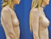 Breast Augmentation - 395cc, teardrop, tall heights, moderate plus profile implants with custom dual plane placement and breast fold incision