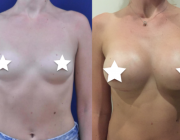 Breast Augmentation - 295cc, Moderate Profile, Teardrop Implants, Under the Muscle