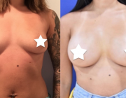 Breast Augmentation -375cc, Round, High Profile Implants, Dual Plane Placement