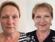 Eyelid Lift, Mid Facelift Neck Lift