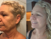 Chin Augmentation, Eyelid Lift Lower, Eyelid Lift Upper and Neck Lift