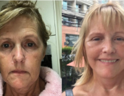 Lower/Mid Facelift, Neck Lift, Eyelid Lift