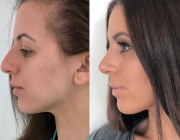 Rhinoplasty (Nose Correction)