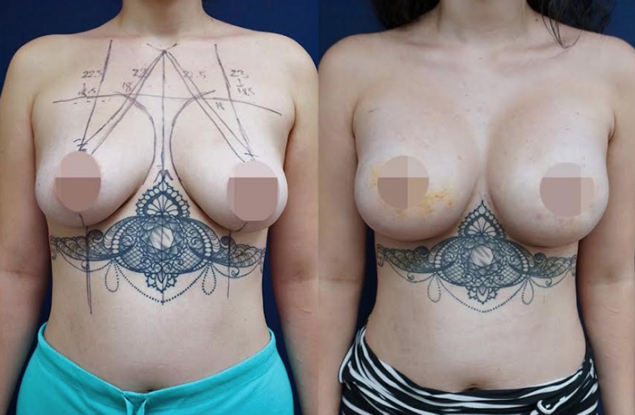Amazing Dr Atikom Breast Lift and Augmentation Results!