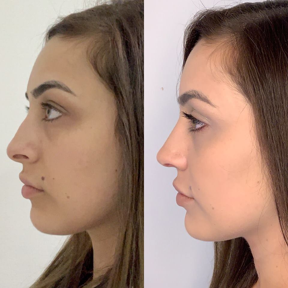 Hannah’s Spectacular Nose Correction by CosMediTour Plastic Surgeon Dr Montien