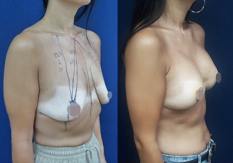 Dr Atikom Helps Mika Get Her Confidence Back with a Breast Lift + Augmentation in Thailand!