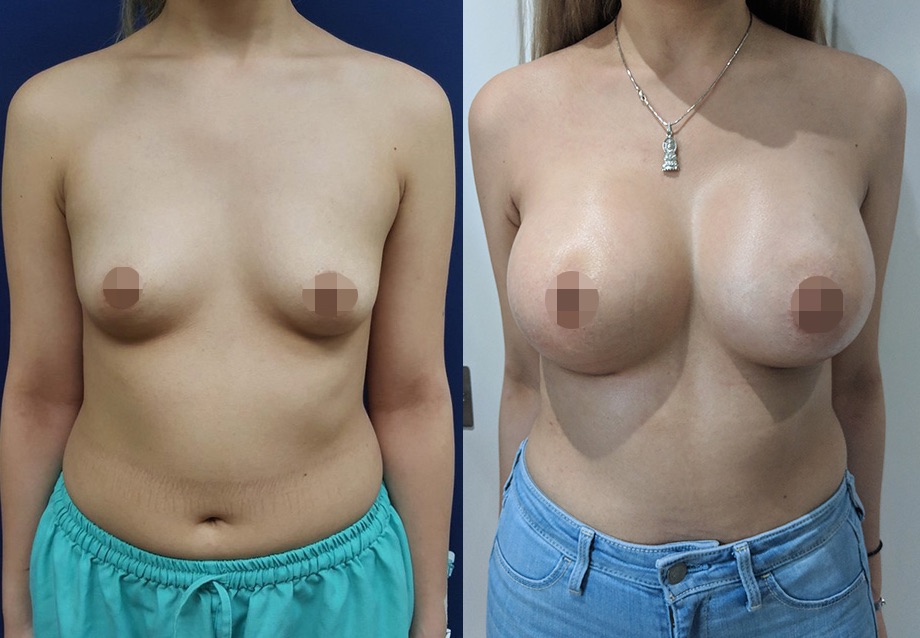 Breast Augmentation Before & After #314