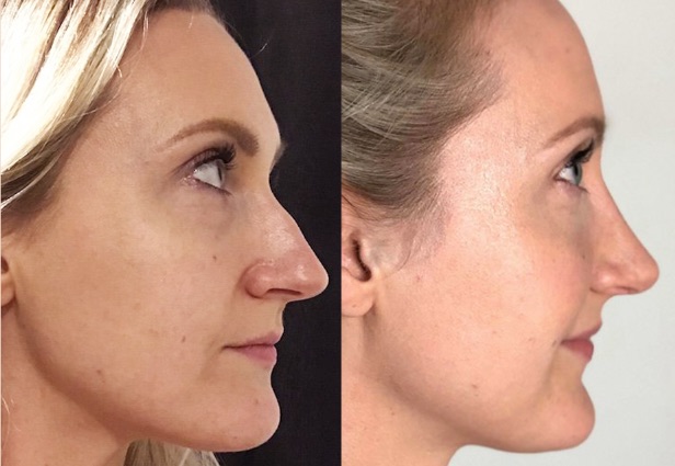Another Incredible Dr Montien Nose Correction!