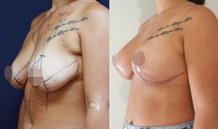 Amazing Dr Atikom Breast Lift with Augmentation Results!
