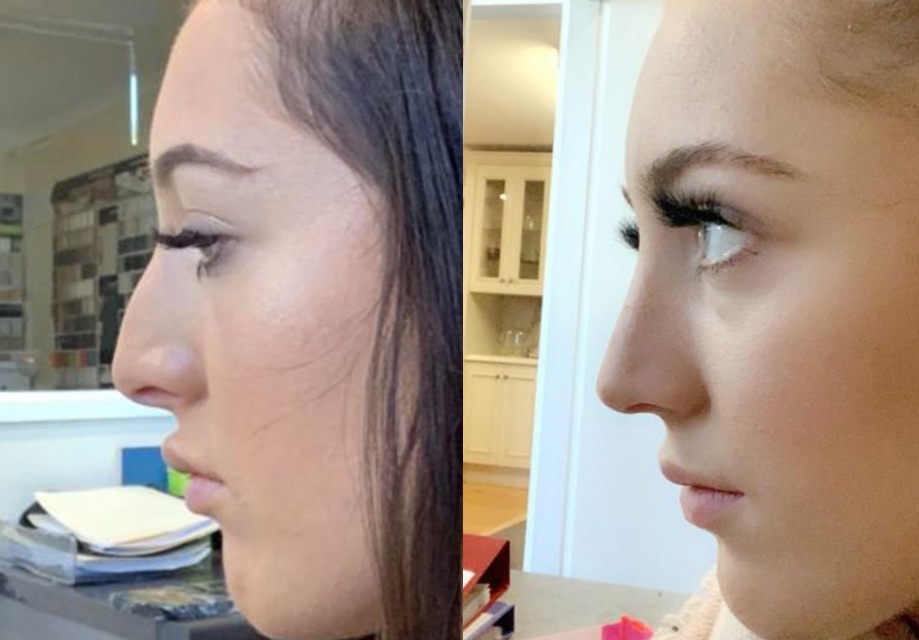 CosMediTour Plastic Surgeon Dr Montien Performs Incredible Hump Reduction Rhinoplasty