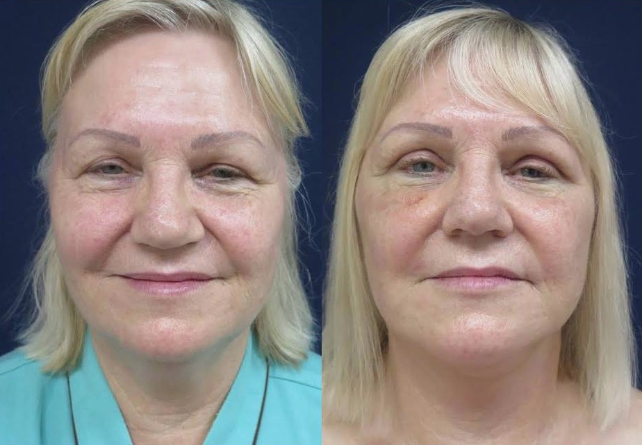 Facelift and Eyelid Lift Before and After #34