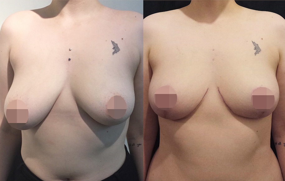Breast Reduction Before & After #13