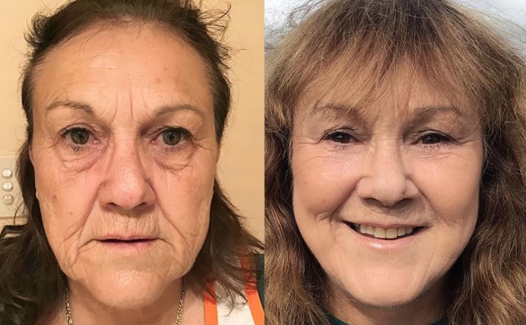 Facelift and Eyelid Lift Before and After #33