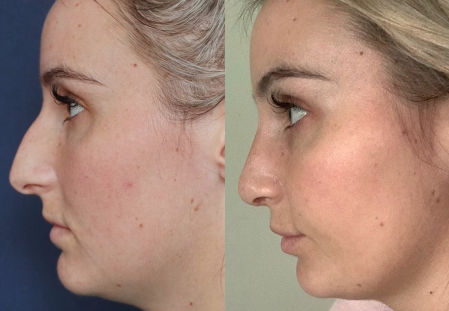 Impressive Dr Supasid Rhinoplasty Results!