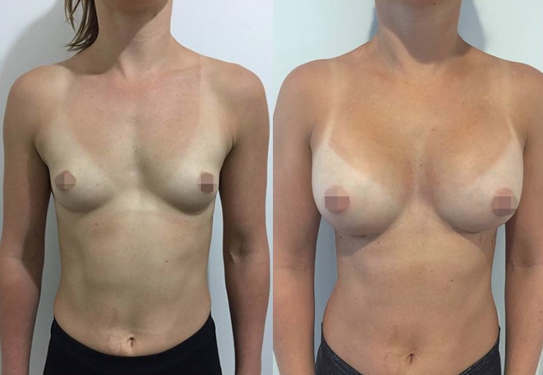 Breast Augmentation Before & After #316