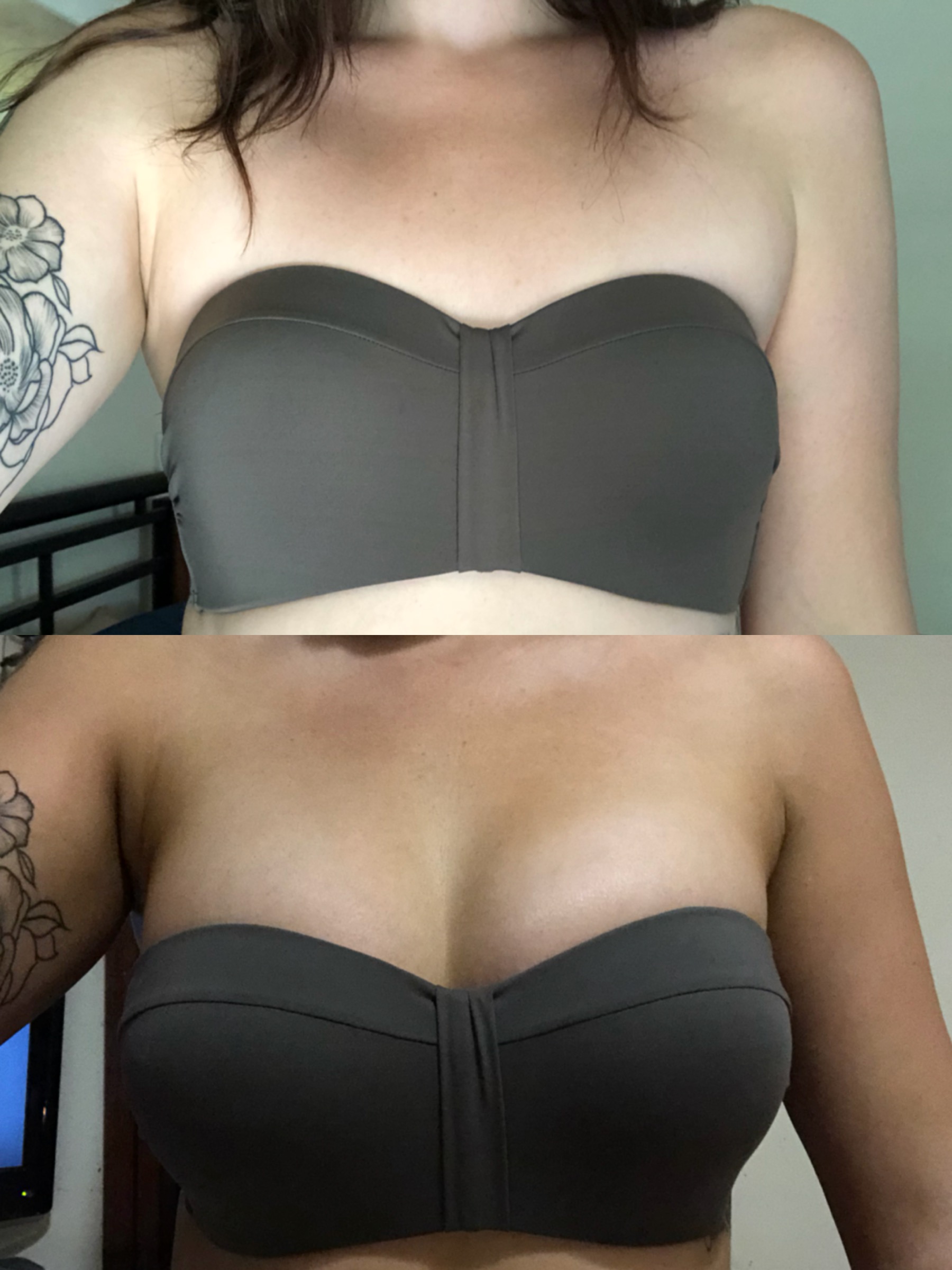 Breast Augmentation Before & After #317