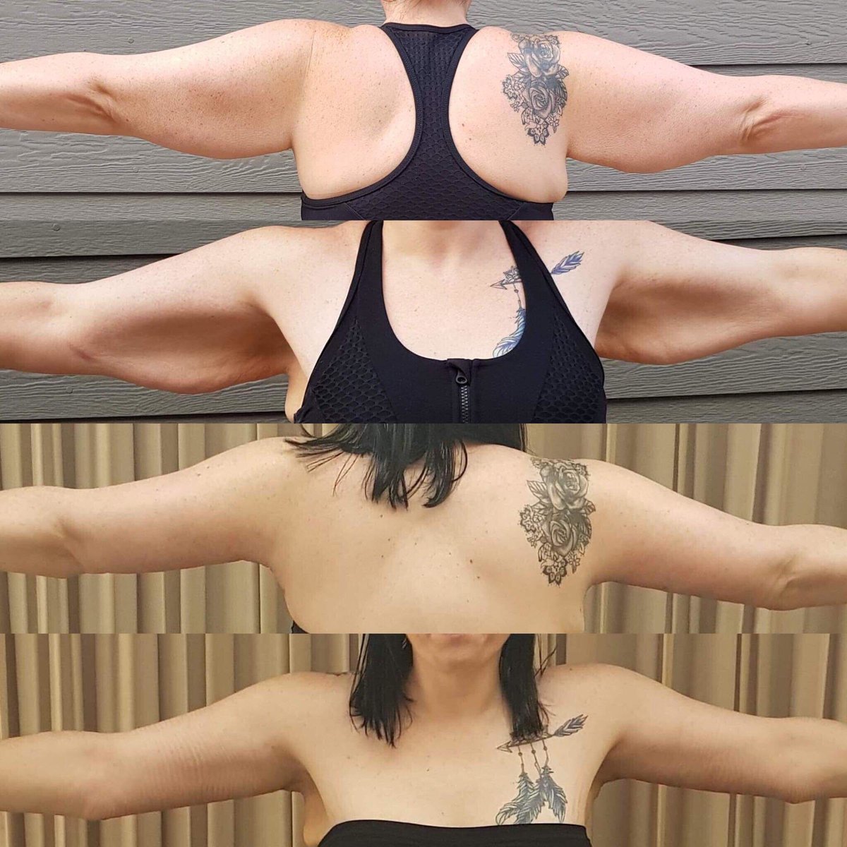 Lesley’s Unbelievable CosMediTour Arm Lift Results!