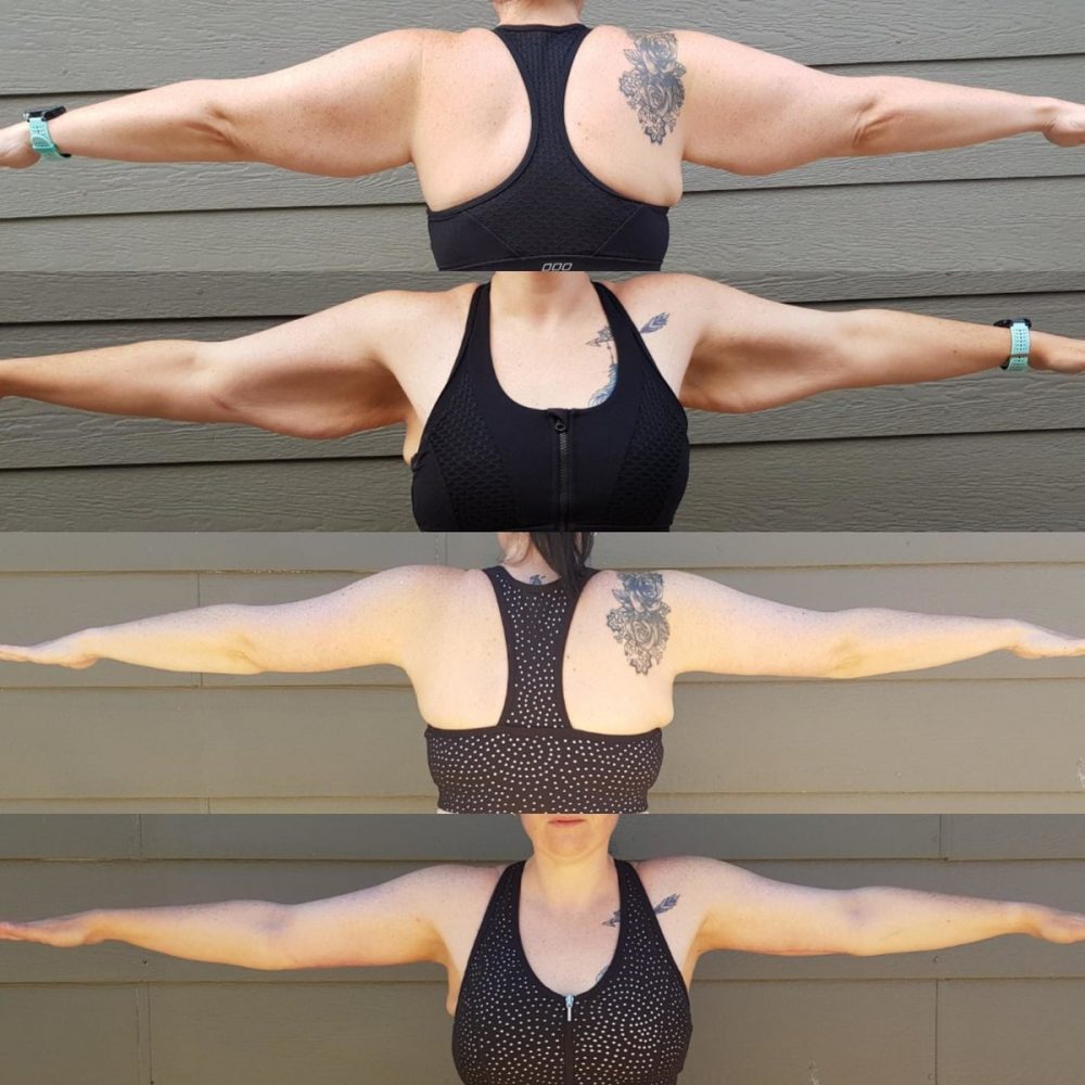 Arm Lift Before and After 17 CosMediTour