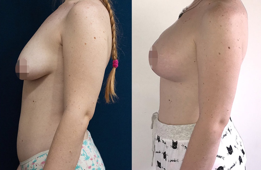 Breast Lift & Augmentation Result #139