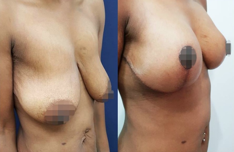 Breast Reduction Before & After #14