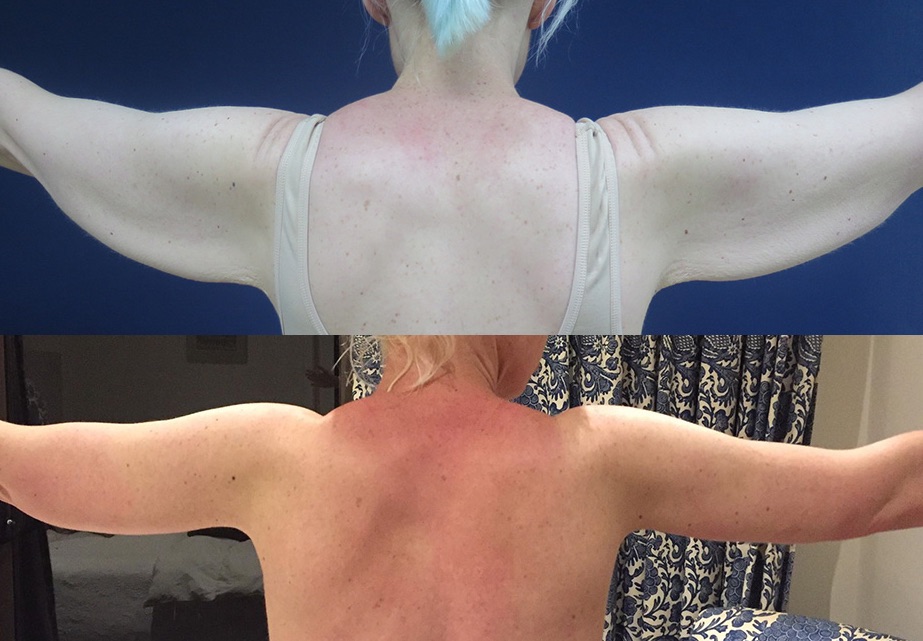 Incredible CosMediTour Arm Lift Before and After Results!