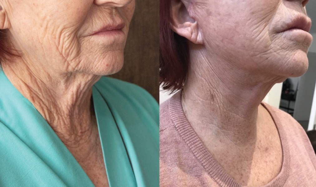 “It’s just brilliant! I am so glad I had it done!” – Alison on her Facelift Surgery in Bangkok