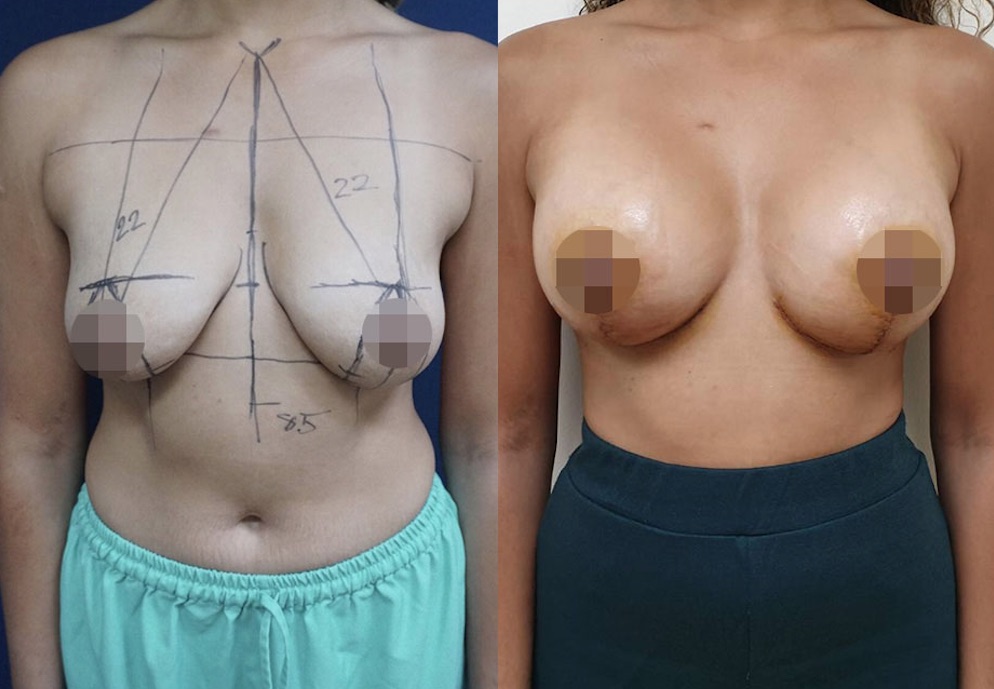 Breast Lift & Augmentation Result #147