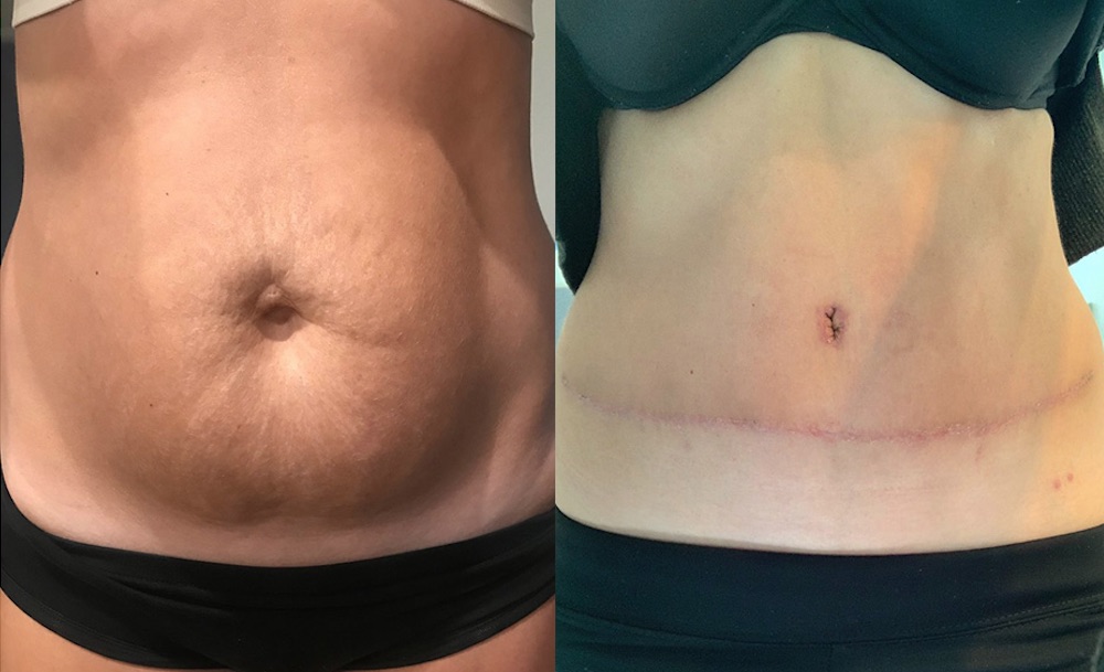 Tummy Tuck Before & After #95