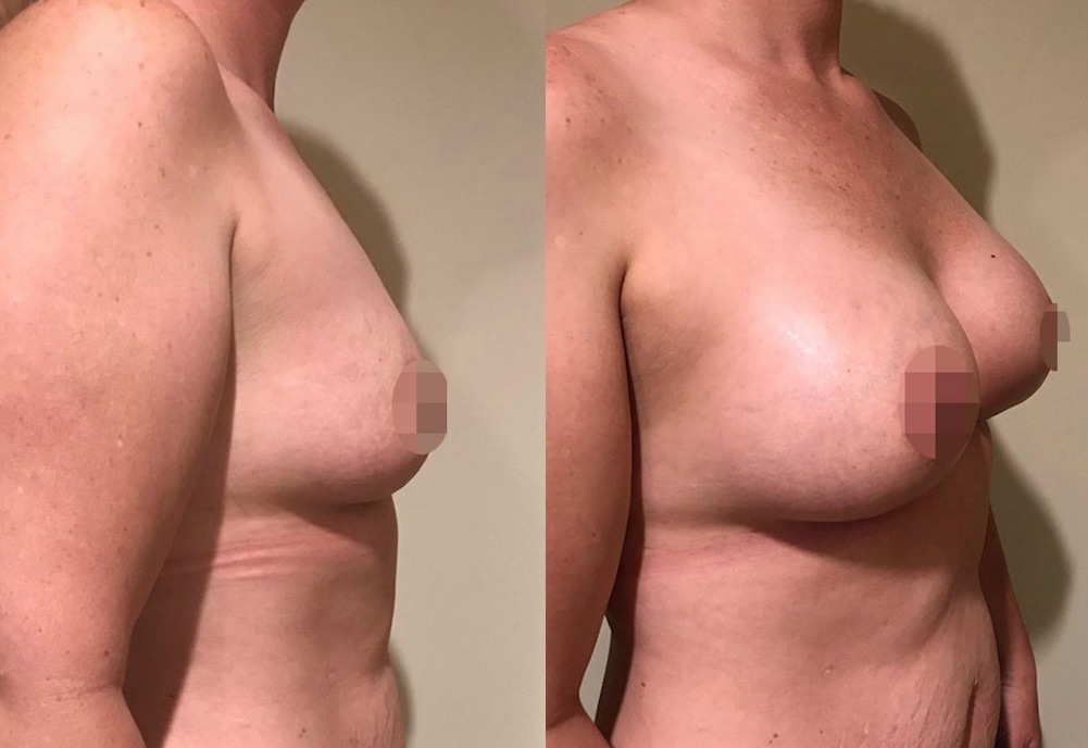 Breast Augmentation Before & After #319