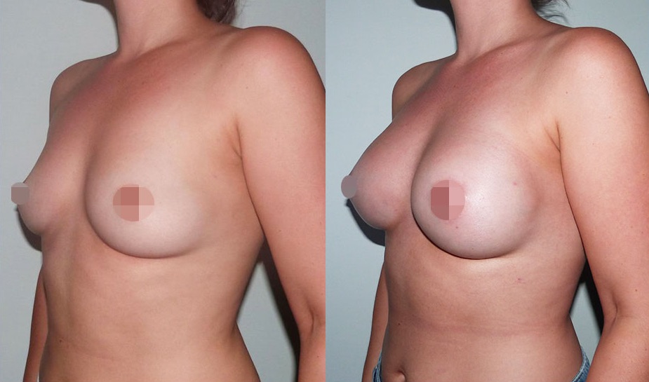 Breast Augmentation Before & After #321