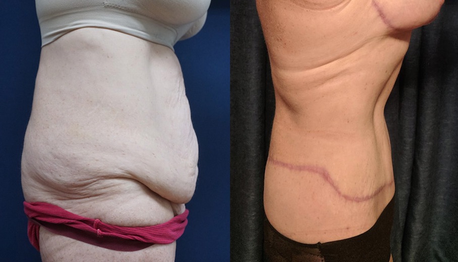 Tummy Tuck Before & After #96