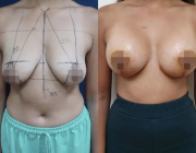 Breast Lift + Augmentation Dr Kamolwan