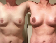 Breast Augmentation Dr Kamolwan