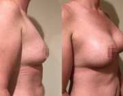 Breast Augmentation Dr Kamolwan