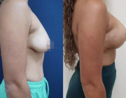Breast Lift + Augmentation Dr Kamolwan