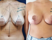 Breast Lift + Augmentation Dr Atikom