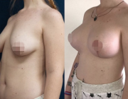 Breast Lift + Augmentation Dr Atikom