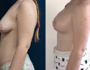 Breast Lift + Augmentation Dr Atikom
