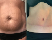 Tummy Tuck Dr Kamolwan