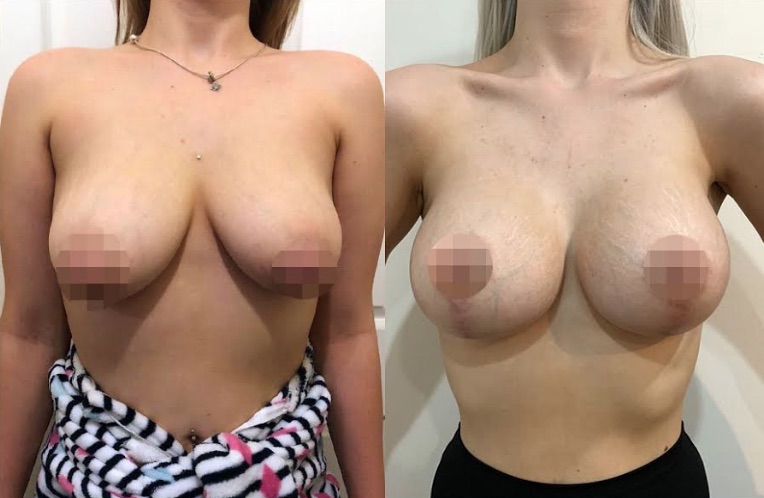 Breast Lift & Augmentation Result #149