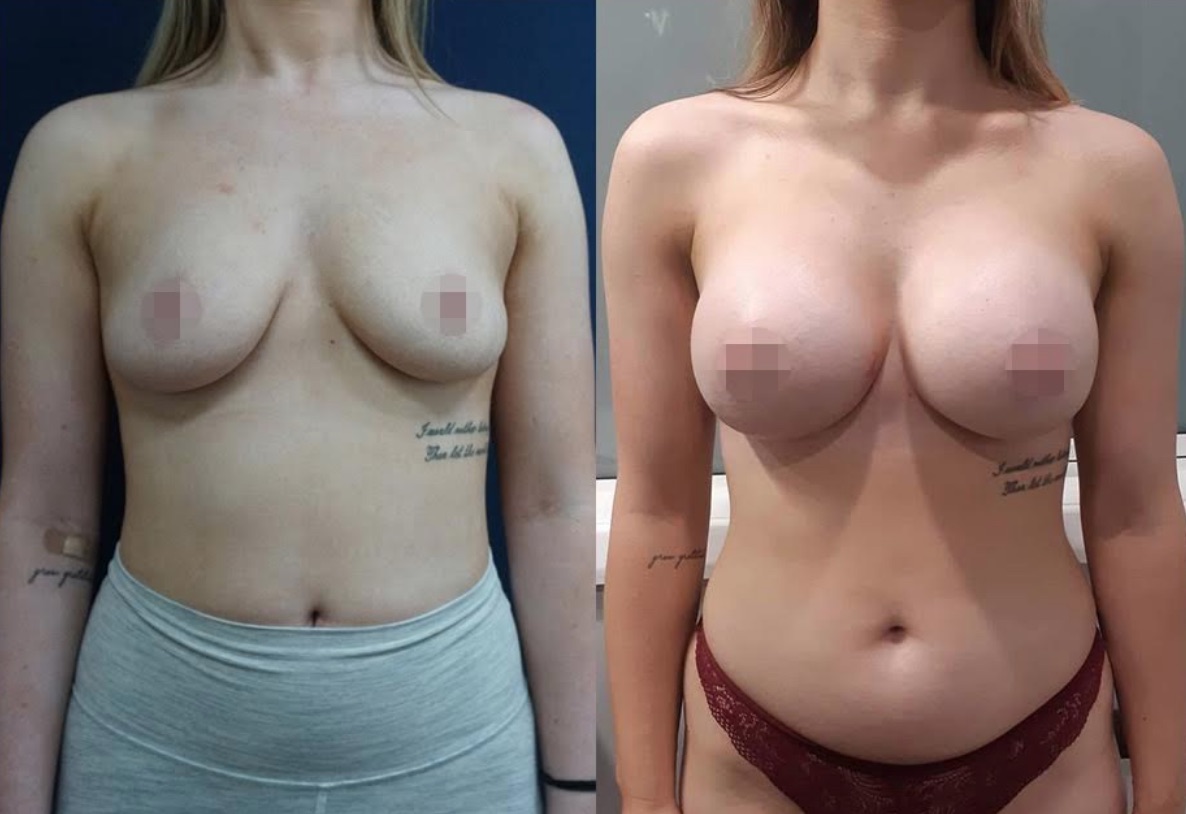 Breast Augmentation Before & After #325