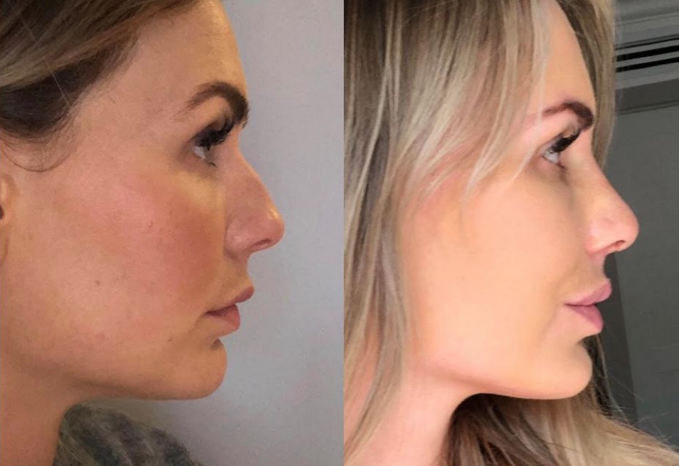 Before & After Rhinoplasty #81