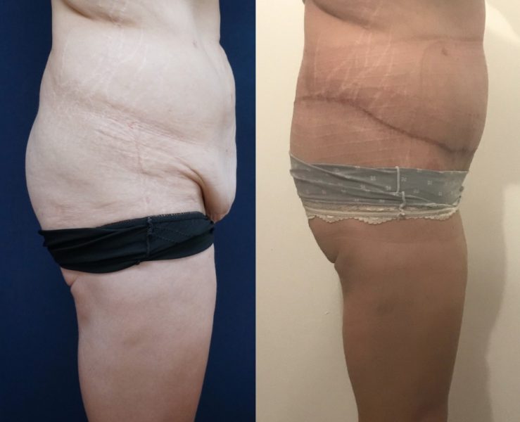 Tummy Tuck Before & After #98 - CosMediTour