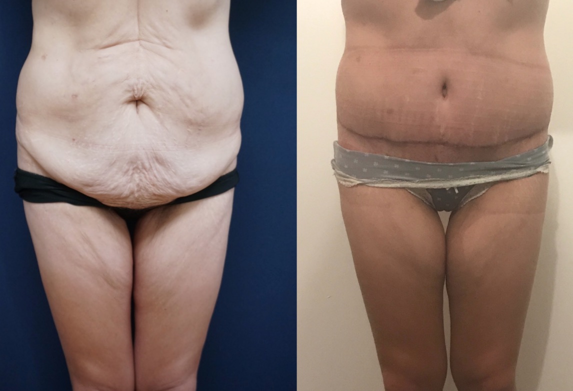 Tummy Tuck Before & After #98